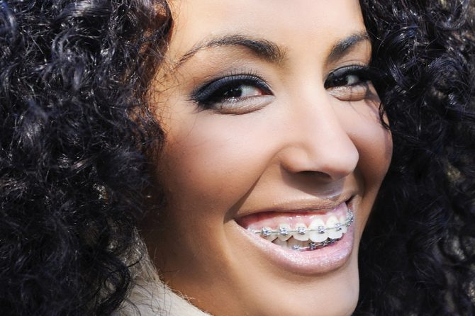 What is it like to get braces put on?