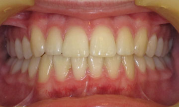 After Orthodontic Treatment Teeth after orthodontic treatment in Hereford