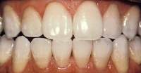 After Teeth Whitening Photo of the mouth after professional teeth whitening in Hereford