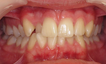 Before Orthodontic Treatment Teeth before orthodontic treatment in Hereford