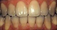 Before Teeth Whitening Photo of the mouth before professional teeth whitening in Hereford