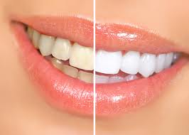 Teeth Whitening Hereford We offer professional teeth whitening services to the residents of Hereford