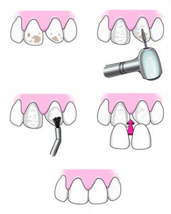 Dental veneer placement procedure