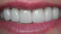 tooth discolouration resolved after dental veneer placement in Hereford